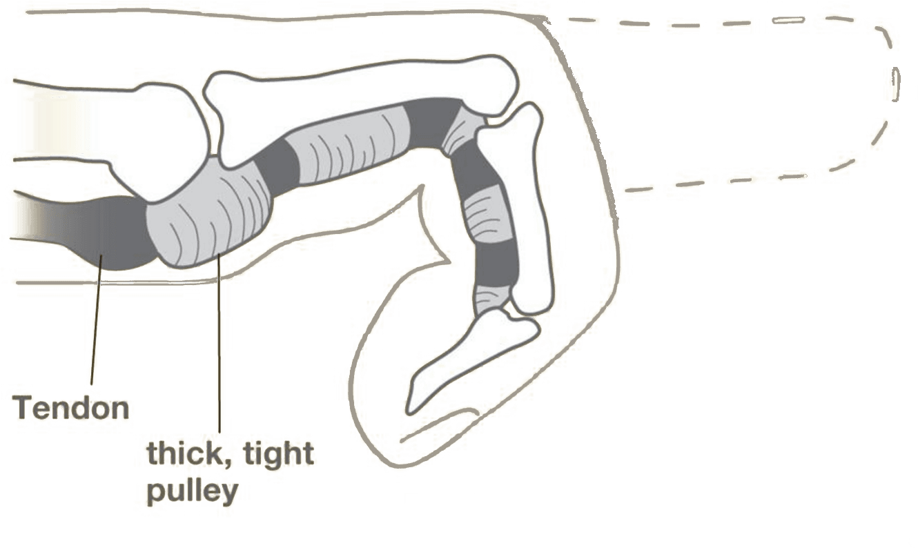 Anatomical illustration showing trigger finger